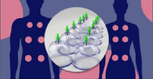 [ FreeCourseWeb ] Udemy - Understanding Cupping Therapy - The Basics