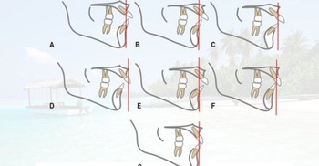 FreeCourseWeb Udemy Orthodontic treatment in the transverse and sagittal planes