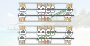 FreeCourseWeb Udemy Finishing the orthodontic case and retention